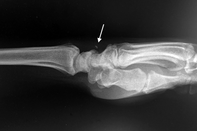 Note the small displaced triquetral "avulsion" fracture (arrow)