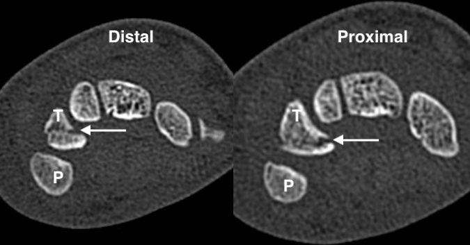 CT cross sectional images of Triquetral (T) Fracture (arrow) with distal and proximal cuts with Pisiform (P)