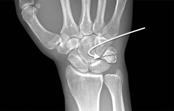 Triquetrum Body Fracture (curved arrow) with overlying pisiform outlined by dotted line