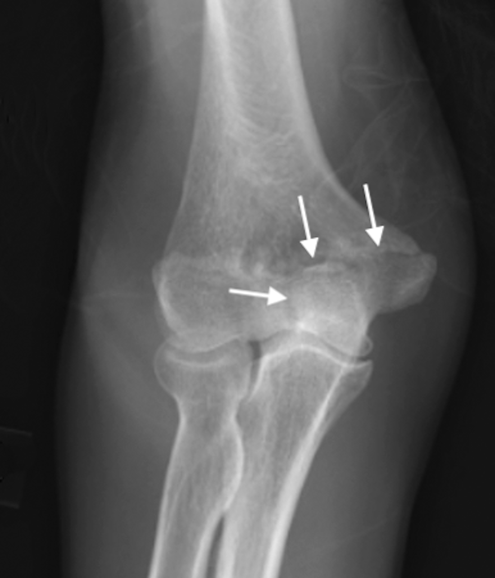 Trochlear Fracture (arrows), AP X-ray, as part of a distal humerus fracture