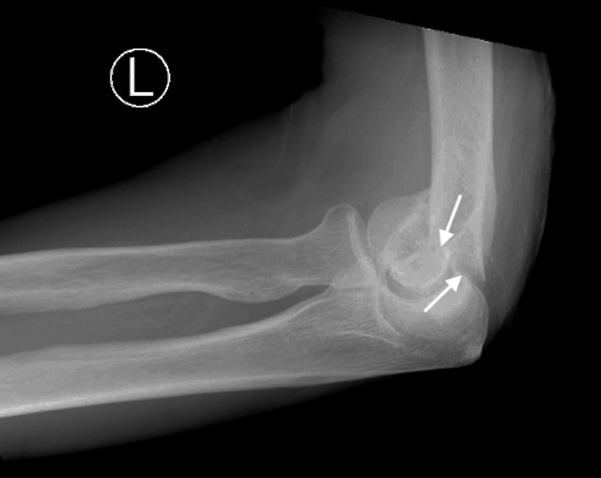 Trochlear Fracture (arrows) as part of a distal humerus fracture