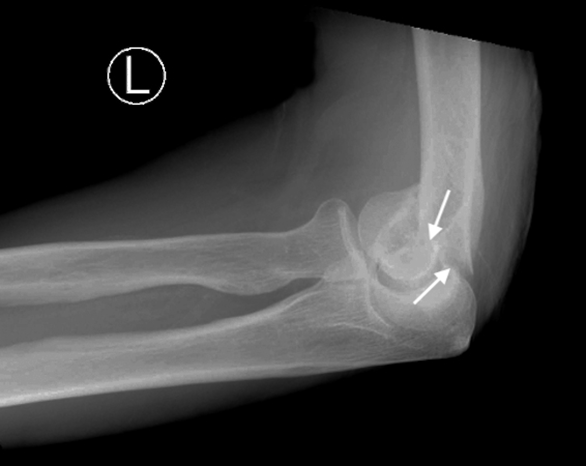 Trochlear Fracture (arrows), Lateral X-ray, as part of a distal humerus fracture