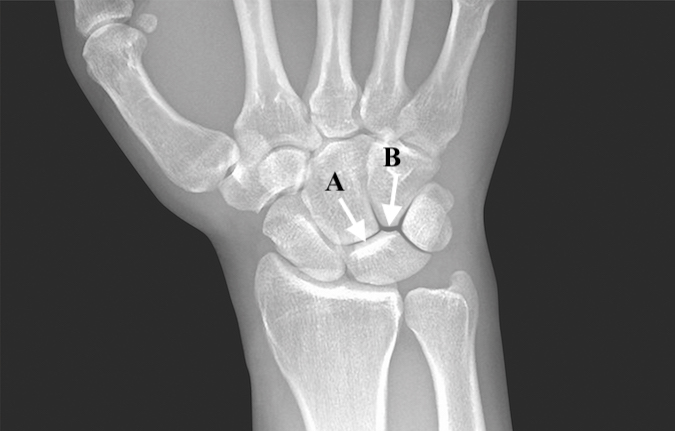 Type II Lunate with only two facets (A) articulating with capitate and (B) articulating with hamate.