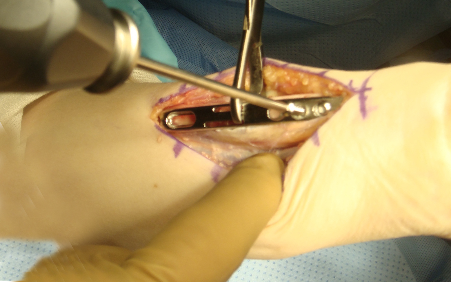 Sliding plate being secured to ulna with distal screws. Plate application volubly with holes for osteotomy guide visible.