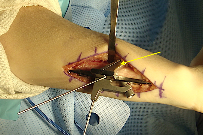 The "A" oblique osteotomy guide(arrow) is held in place with a K-wire. The "A" guide determines the amount of bone resection.  Apply saline irrigation while cutting osteotomies to minimize heat damage to the ulna.