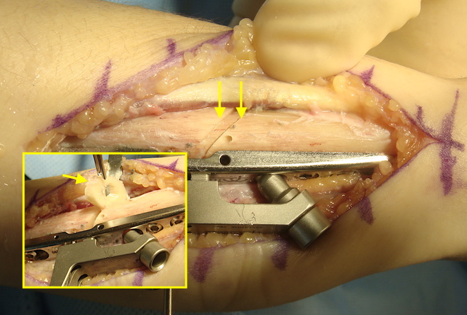 Both osteotomy cuts have been completed (see arrows).