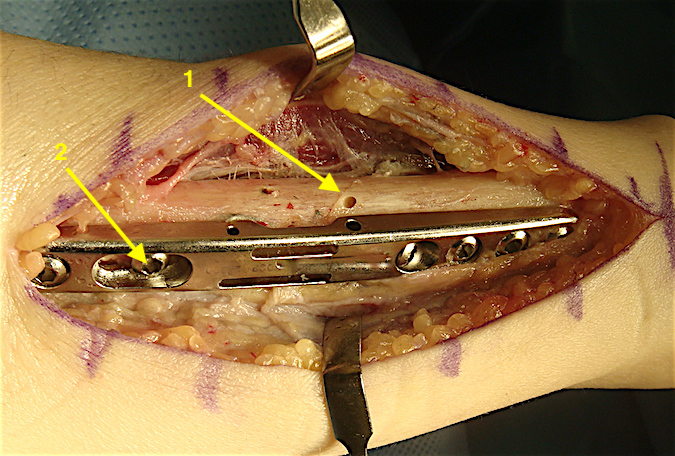 Osteotomy closed and internal fixation screws all in place in the oblique screw crossing the osteotomy.