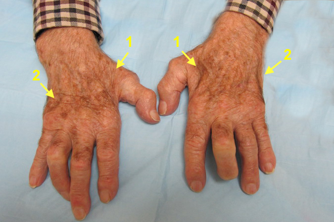 Combined Ulnar and Median Nerve Palsies.  Note first dorsal interosseous atrophy (1) and hypothenar atrophy (2). 