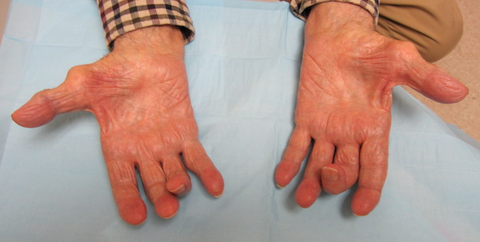 Combined Ulnar and Median Nerve Palsies with ulnar intrinsic atrophy, thenar atrophy and loss of the palmar arches.