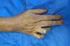 Patient with chronic clawing after ulnar laceration of wrist repaired years ago.