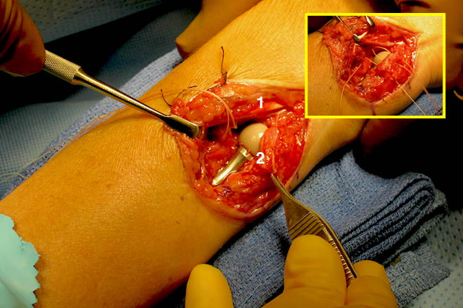 Ulnar head arthroplasty for DRUJ OA.  Note retracted extensor tendons (1) and capsule edge (2) with insert showing capsular closer.