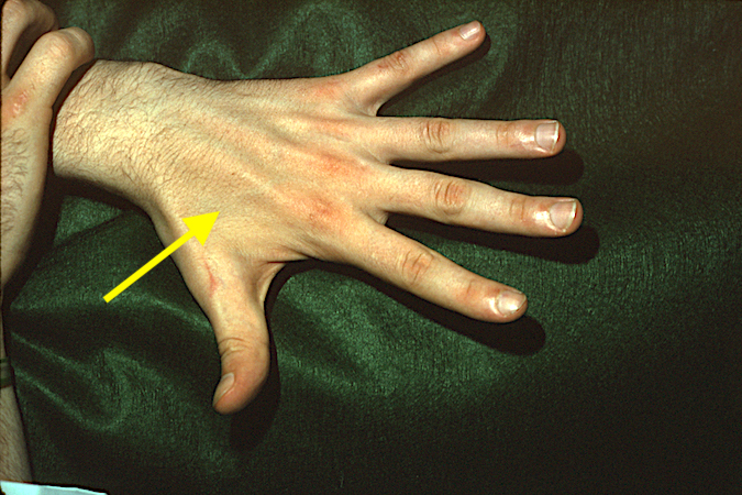 Ulnar Nerve Palsy with significant first dorsal interosseous atrophy (arrow)