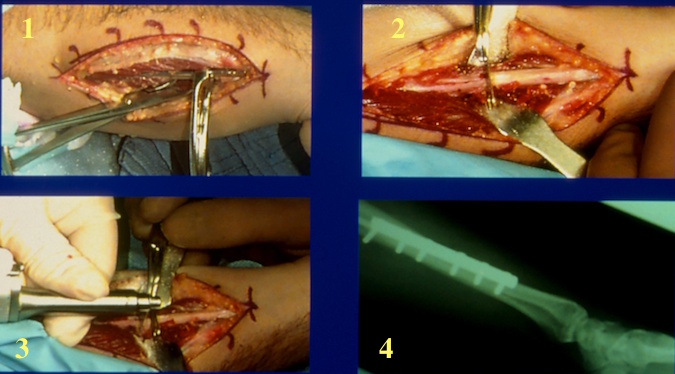 1. Plate being positioned on the ulna. 2. First cut of the osteotomy. 3.Second osteotomy cut. 4. Completed ORIF of osteoplasty.