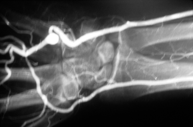 Angiogram of right ulnar artery aneurysm