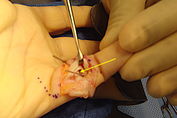 Volar plate rupture left little finger being repaired. Flexors retracted.  Keith needles for pullout suture in place. Volar plate edge seen (arrow).