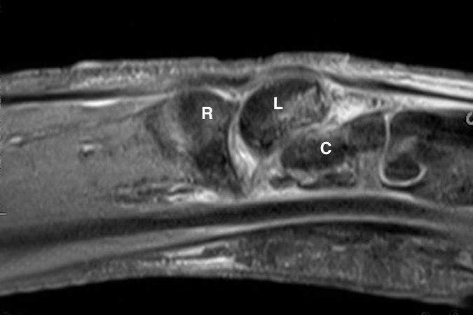 Volar perilunate dislocation MRI. Note capitate(C), lunate(L) and radius (R.)