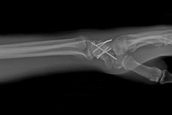 Volar perilunate dislocation lateral X-ray (insert) reduction, pinning and ligament repairs.