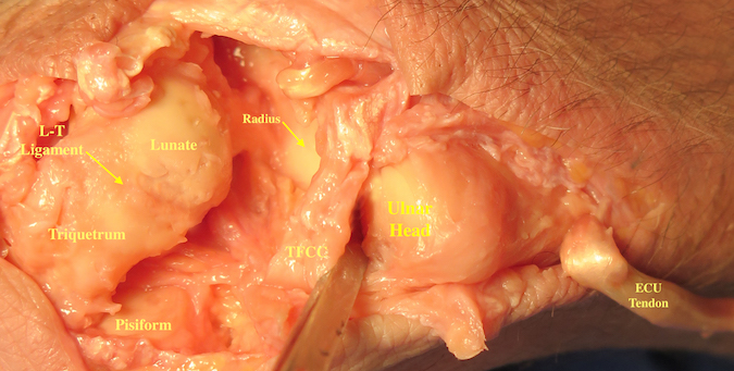 The anatomic specimen shows the open ulnar part of the wrist. The lunate, the lunotruetral ligament and the triquetrum are on the left of the image. The triquetral pisiform ligaments have been cut showing the dorsal articular surface of the pisiform. The ulnar edge of the radius, the TFCC, the head of the ulna and the cut ECU tendon are also shown.