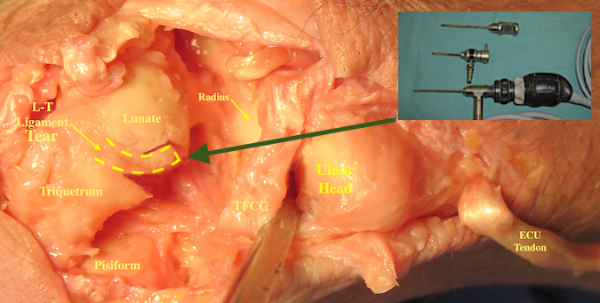 Small acute L-T Tears can often be treated by arthroscopic debridement +/- L-T joint pinning.