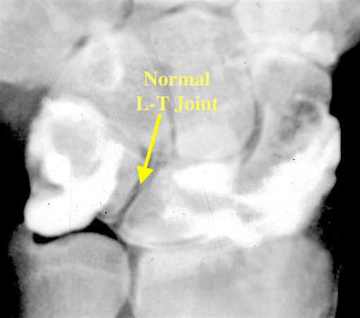 Wrist arthrogram showing an intact L-T ligament