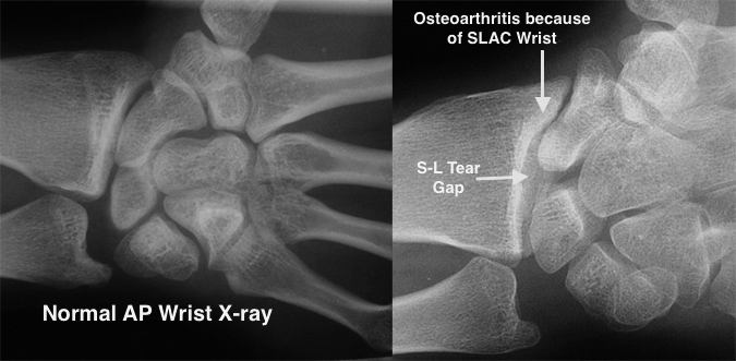 Normal wrist and arthritic wrist