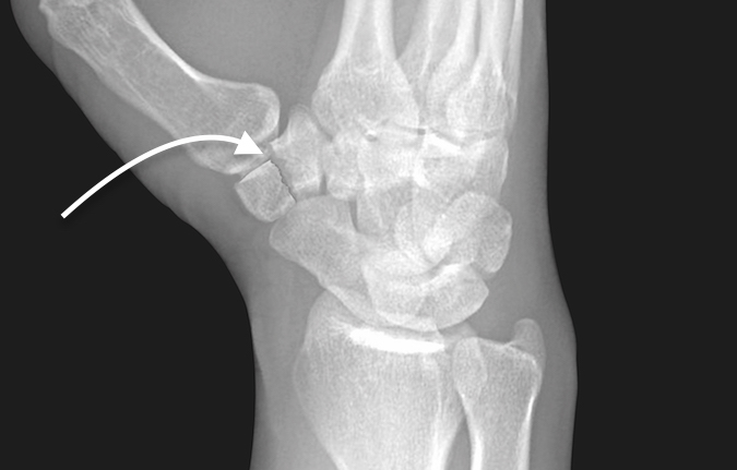 Displaced trapezial body fracture (arrow)