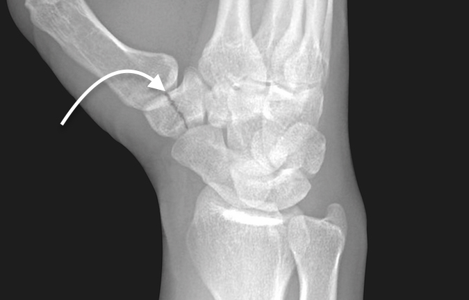 Nondisplaced trapezial body fracture (arrow)