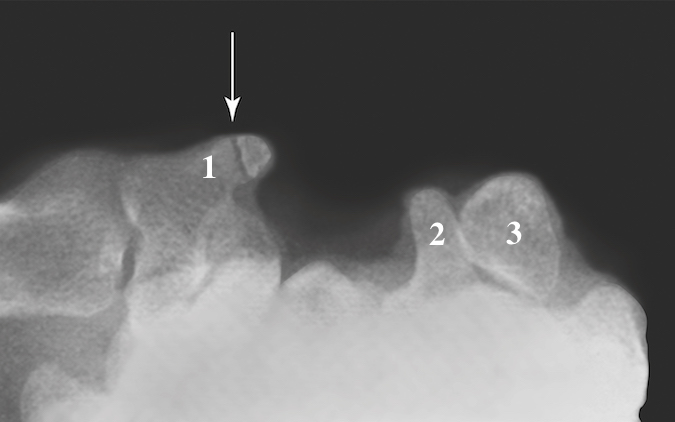 Carpal tunnel view showing nondisplaced trapezial ridge fracture (arrow)