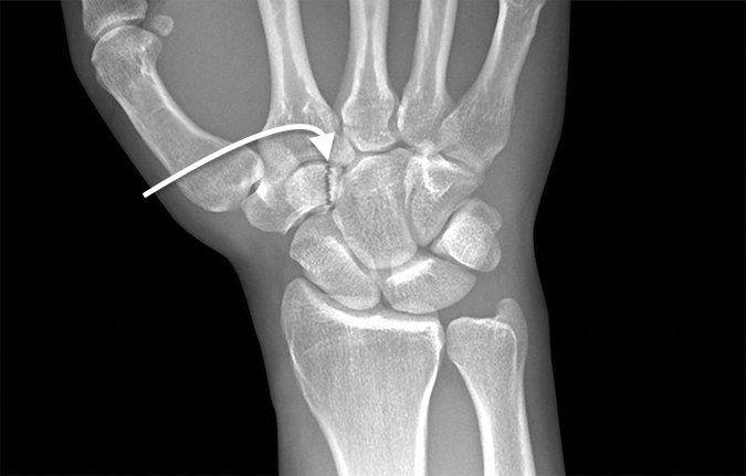 Nondisplaced trapezoid body fracture (arrow)
