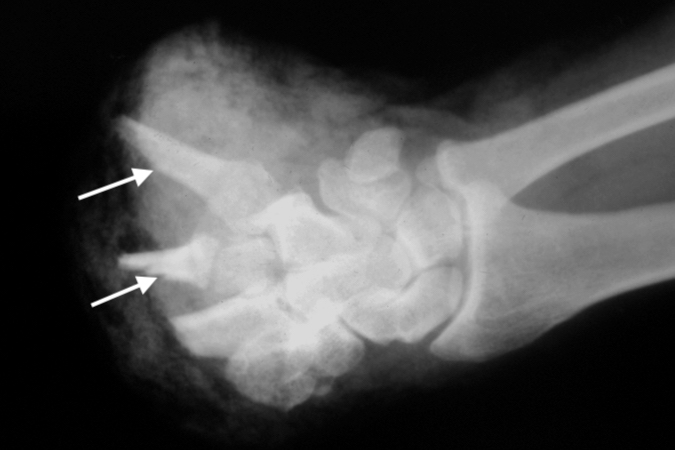 X-ray of hand amputation stump. Note arrows at sites for bone shortening prior to replantation surgery.