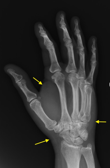 Cat bite to the right hand with marked soft tissue swelling (arrows) after only 24 hours