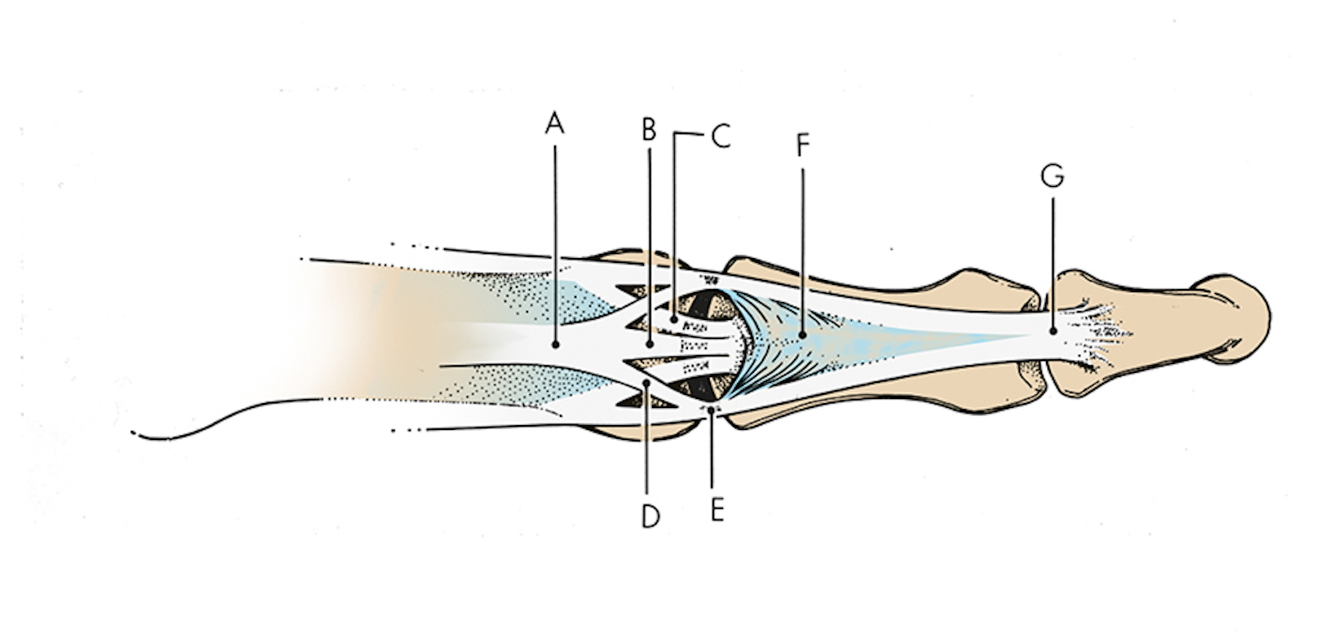 Finger extensor tendon anatomy dorsal view: A. Extensor tendon; B. Central slip; C. Oblique fibers of the dorsal aponeurosis; D. Lateral slip; E. Conjoined lateral band; F. Triangular ligament; G. Terminal extensor tendon