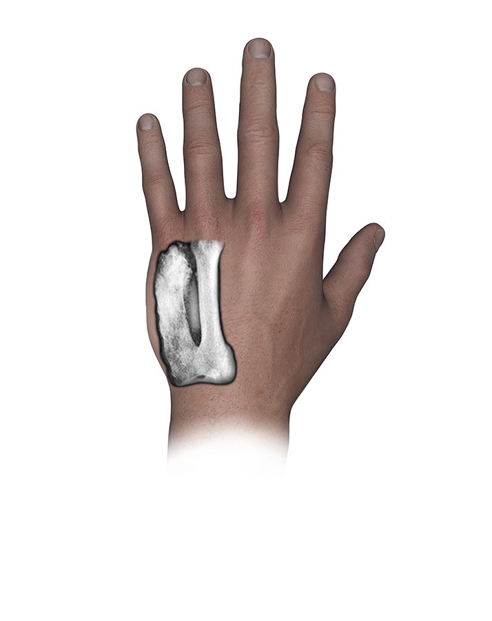  X-ray of the left fifth metacarpal osteosarcoma