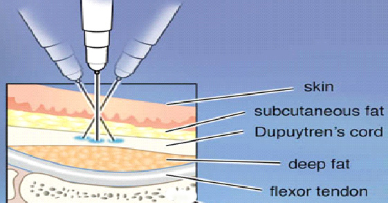 Older Injection technique for dividing single dose into aliquots