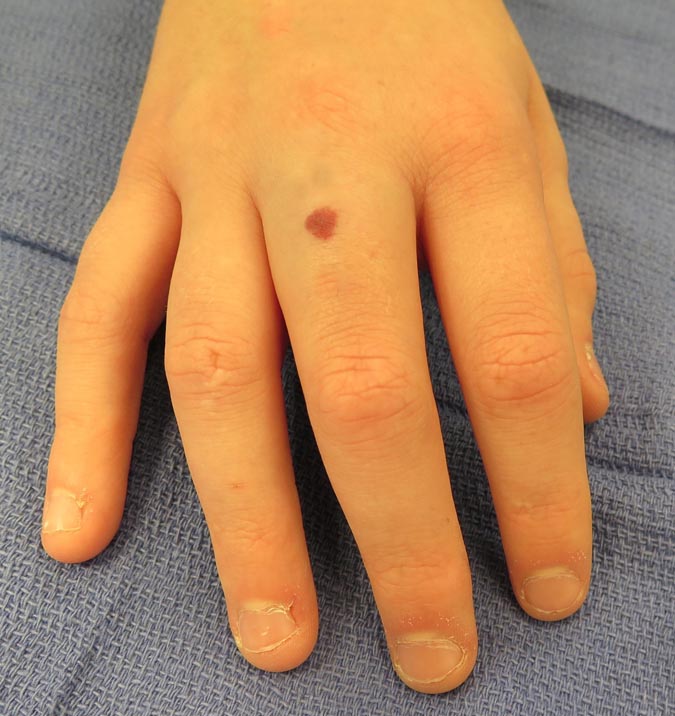 Hemangioma with skin involvement