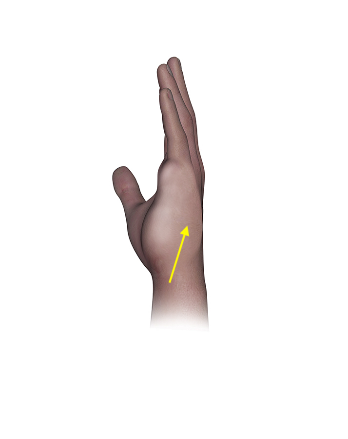  Osteosarcoma of the left fifth metacarpal with ulnar swelling (arrow)