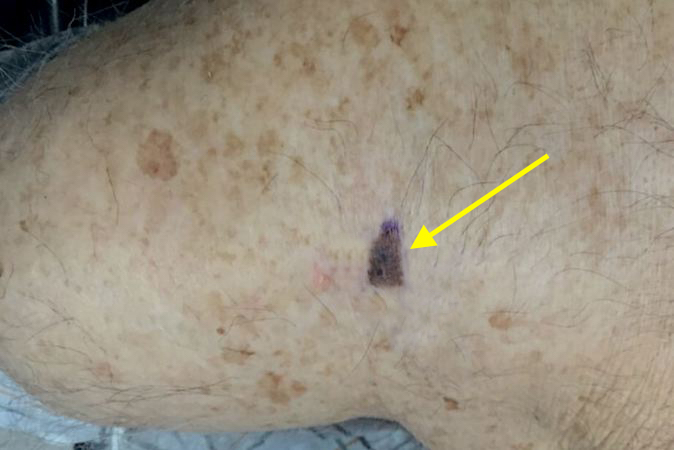 Melanoma right anterior axilla (arrow)