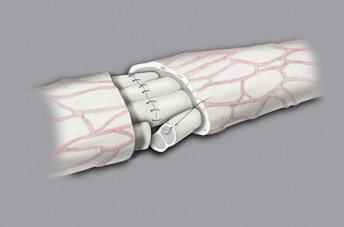 Group fascicular microsurgical repair of median nerve laceration.  Internal epineurium sutured.