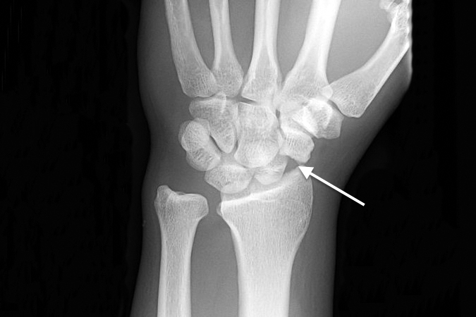 Trans-Scaphoid perilunate fracture dislocation.  Note the scaphoid fracture (arrow), disrupted Gilula's lines and excessive scaphoid capitate overlap.