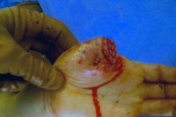Thumb amputation through proximal phalanx guillotine amputation.