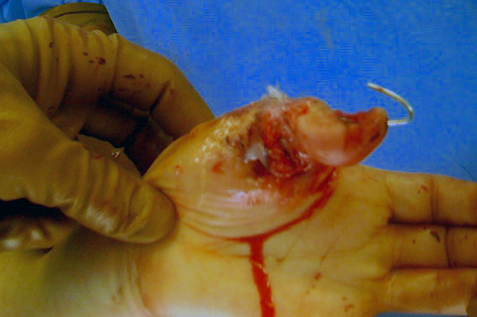 Successful thumb replantation immediately after surgery.