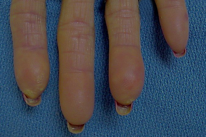Raynaud phenomenon color changes in a patient with scleroderma.