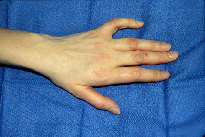 Ulnar Nerve Palsy with Wartenberg sign (Note abduction contracture of fifth finger)