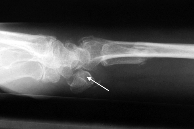 Right lunate dislocation lateral X-ray volarly displaced lunate (arrow)