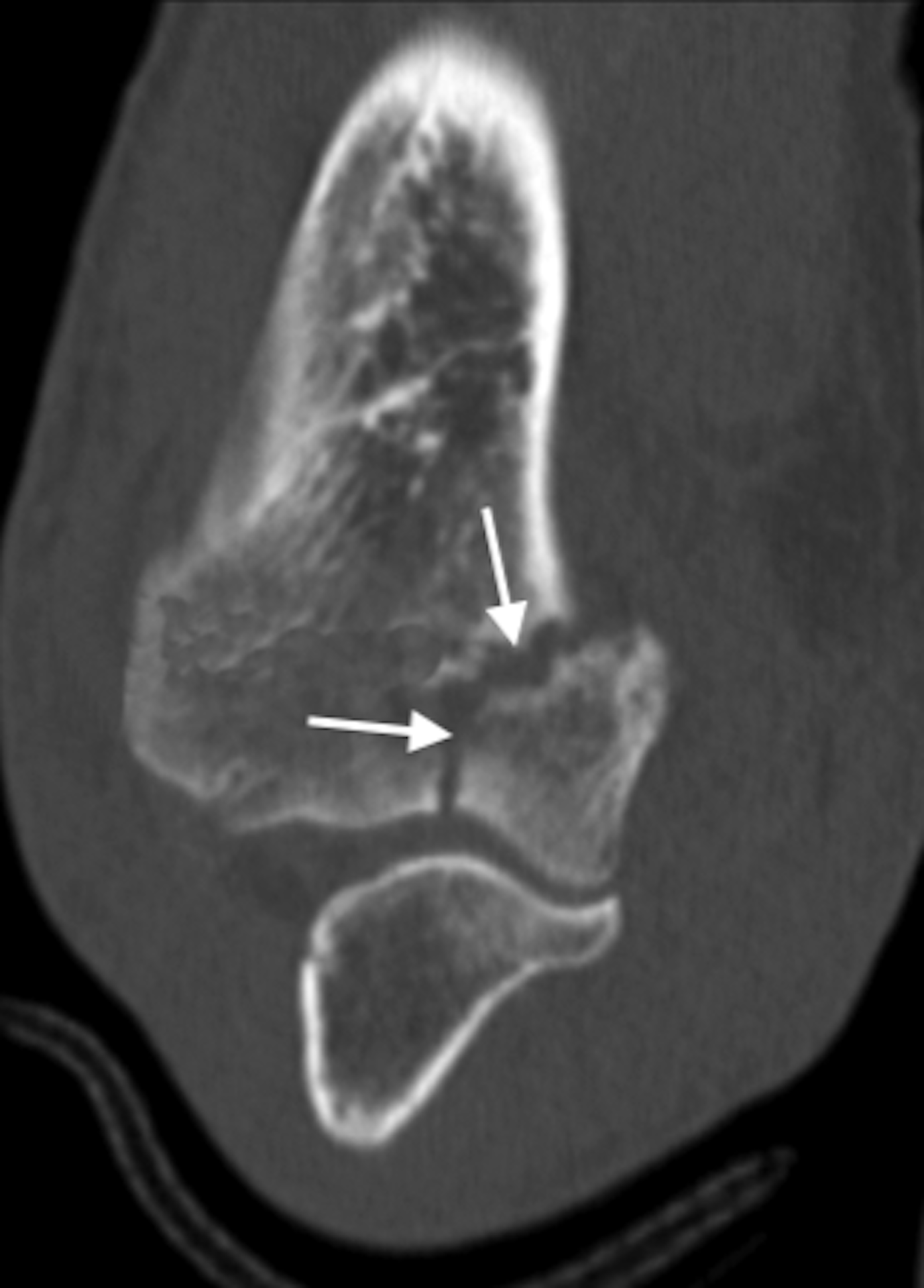 Trochlear Fracture (arrows), CT Scan, as part of a distal humerus fracture