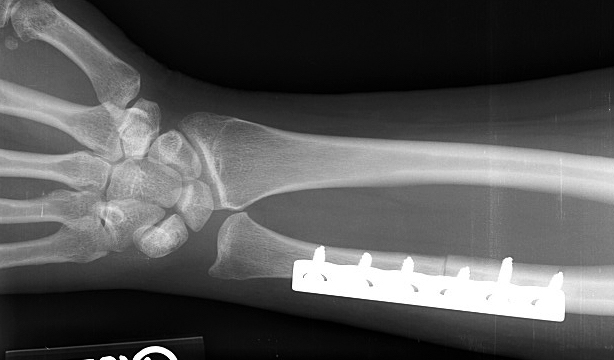 Ulnocarpal abutment and L-T Tear treated with ulnar shortening osteoplasty.